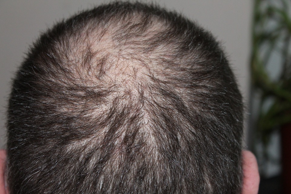 men's-hair-loss